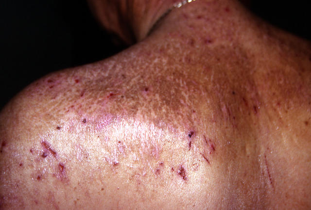 DERMATITIS - EKZEMA - Neurodermatitis DERMATITIS - EKZEMA - Neurodermatitis
