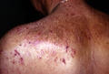 DERMATITIS - EKZEMA - Neurodermatitis