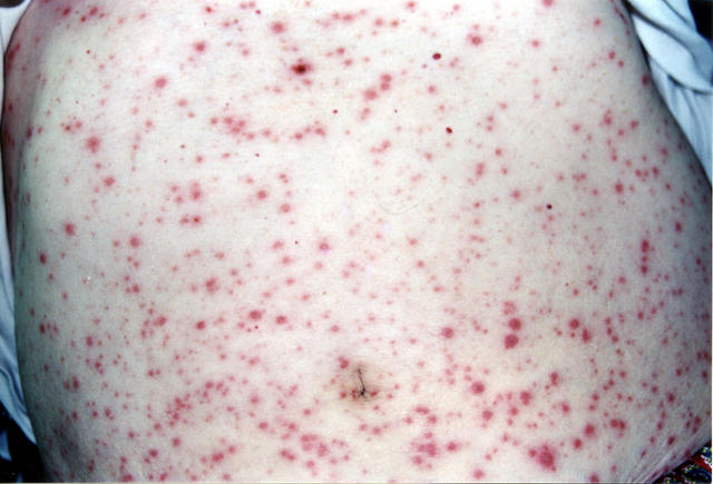 DRUG ERUPTIONS - Drug eruption DRUG ERUPTIONS - Drug eruption
