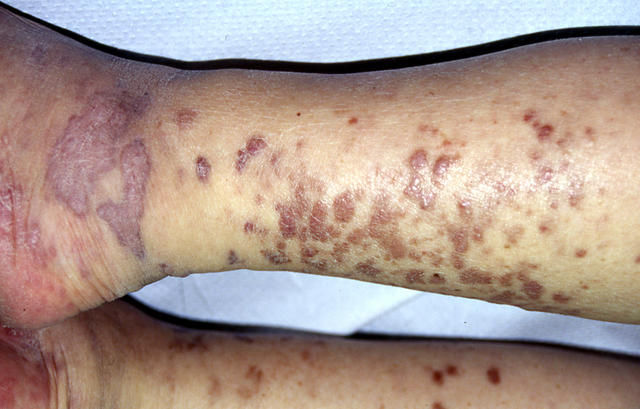 SOFT TISSUE TUMORS - Kaposi sarcoma