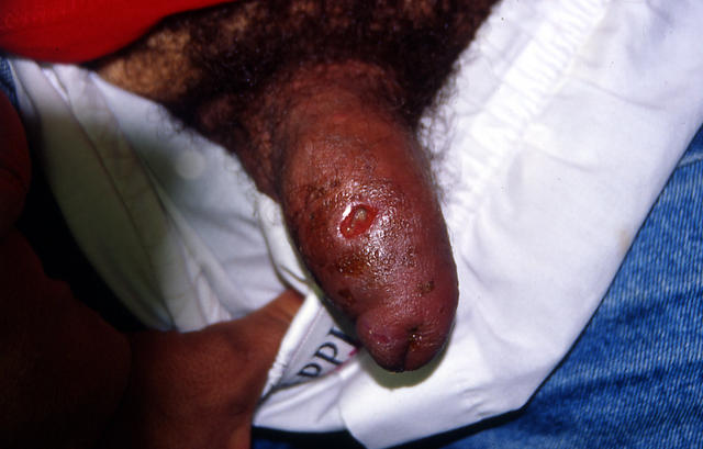 Syphilis Symptoms, Causes, and Diagnosis - WebMD