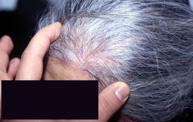 SUPERFICIAL FUNGAL INFECTIONS - Tinea capitis in an adult