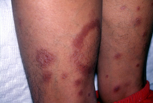 BACTERIAL INFECTIONS - Hansen disease BACTERIAL INFECTIONS - Hansen disease