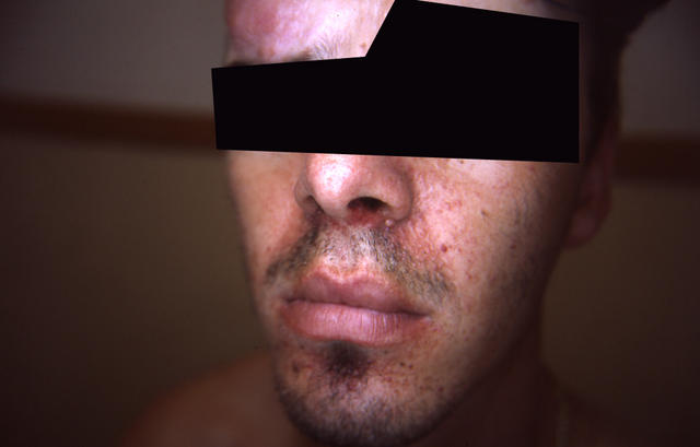 GENODERMATOSES - Tuberous sclerosis complex GENODERMATOSES - Tuberous sclerosis complex