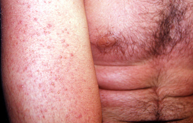 DRUG ERUPTIONS - Drug eruption DRUG ERUPTIONS - Drug eruption