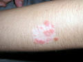 PSORIASIS - Psoriasis on vitiligo lesion