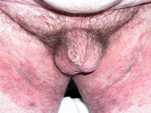 SUPERFICIAL FUNGAL INFECTIONS - Tinea incognito SUPERFICIAL FUNGAL INFECTIONS - Tinea incognito