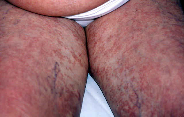 DRUG ERUPTIONS - Drug eruption DRUG ERUPTIONS - Drug eruption