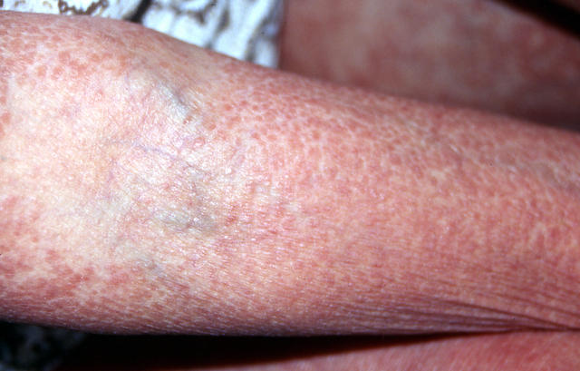 DRUG ERUPTIONS - Drug eruption DRUG ERUPTIONS - Drug eruption