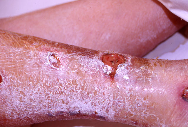 BULLOUS DISEASES - Pemphigus vulgaris BULLOUS DISEASES - Pemphigus vulgaris