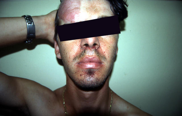 GENODERMATOSES - Tuberous sclerosis complex GENODERMATOSES - Tuberous sclerosis complex