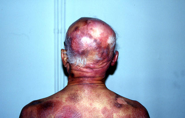 LYMPHOMAS - LYMPHOCYTIC INFILTRATIONS - Mycosis Fungoides