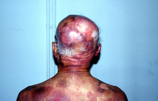 LYMPHOMAS - LYMPHOCYTIC INFILTRATIONS - Mycosis Fungoides LYMPHOMAS - LYMPHOCYTIC INFILTRATIONS - Mycosis Fungoides