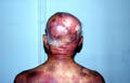 LYMPHOMAS - LYMPHOCYTIC INFILTRATIONS - Mycosis Fungoides