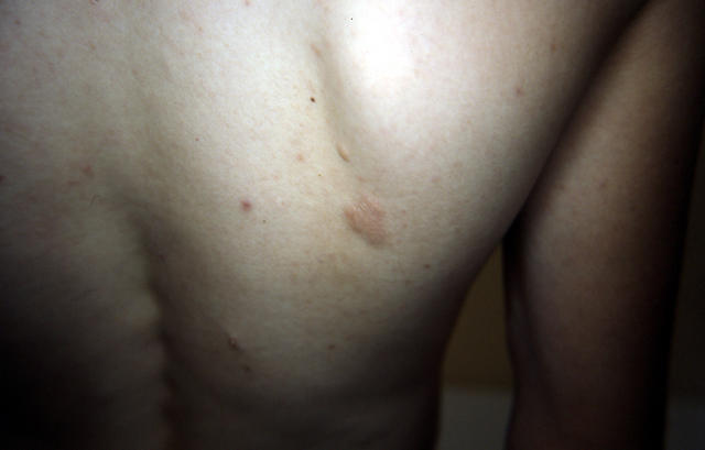 GENODERMATOSES - Tuberous sclerosis complex GENODERMATOSES - Tuberous sclerosis complex