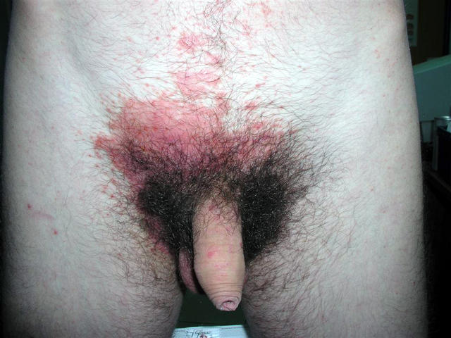 BACTERIAL INFECTIONS - Impetigo BACTERIAL INFECTIONS - Impetigo