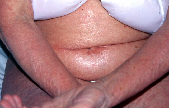 DRUG ERUPTIONS - Drug eruption DRUG ERUPTIONS - Drug eruption