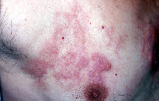 LYMPHOMAS - LYMPHOCYTIC INFILTRATIONS - Mycosis Fungoides