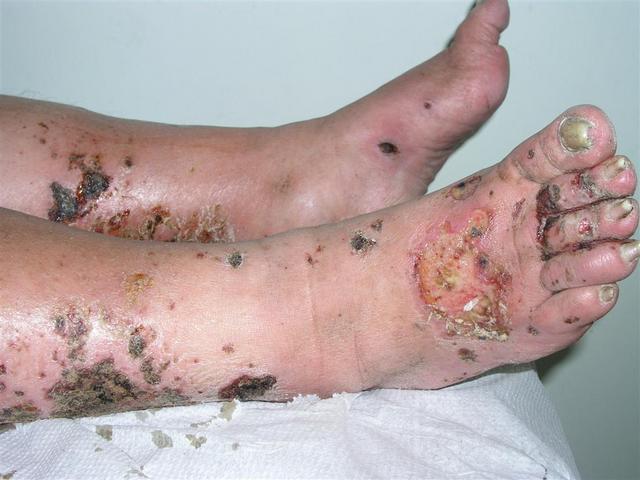 DISEASE OF THE BLOOD AND THE VESSELS – PURPURAS - Leukocytoclastic vasculitis