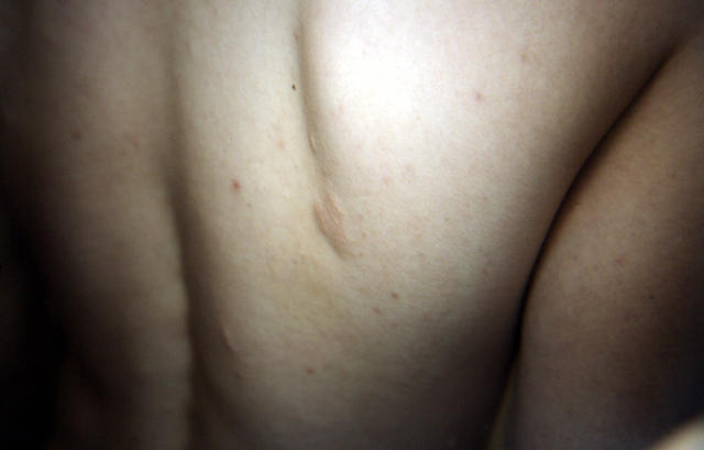GENODERMATOSES - Tuberous sclerosis complex GENODERMATOSES - Tuberous sclerosis complex