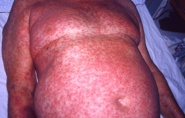DRUG ERUPTIONS - Drug eruption DRUG ERUPTIONS - Drug eruption