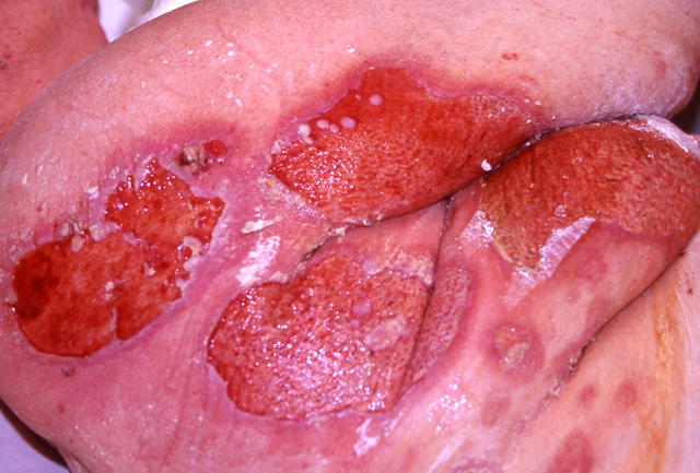 BULLOUS DISEASES - Pemphigus vulgaris BULLOUS DISEASES - Pemphigus vulgaris