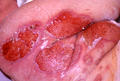 BULLOUS DISEASES - Pemphigus vulgaris