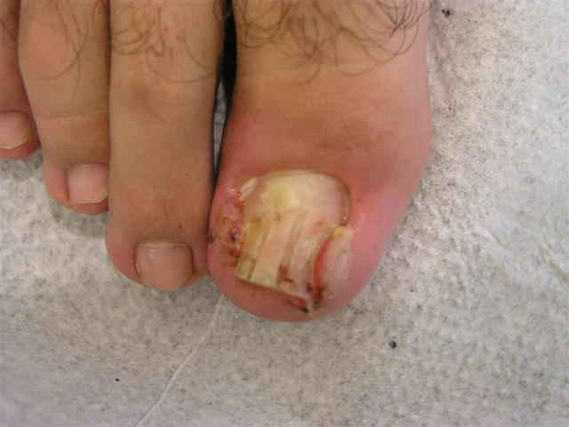 NAIL DISEASES - Ingrowing nail