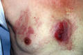 LYMPHOMAS - LYMPHOCYTIC INFILTRATIONS - Mycosis Fungoides