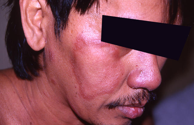 BACTERIAL INFECTIONS - Hansen disease BACTERIAL INFECTIONS - Hansen disease