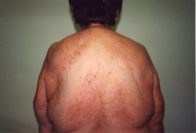 DERMATITIS - EKZEMA - Neurodermatitis