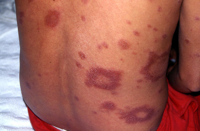 BACTERIAL INFECTIONS - Hansen disease