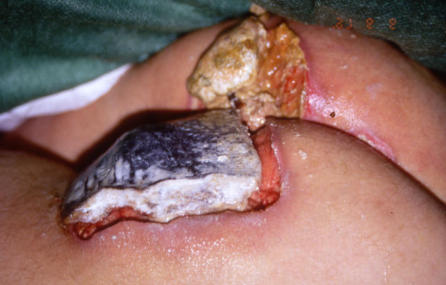 SKIN LESIONS IN HIV-AIDS PATIENTS - Perianal ulcers due to HSV and CMV infections