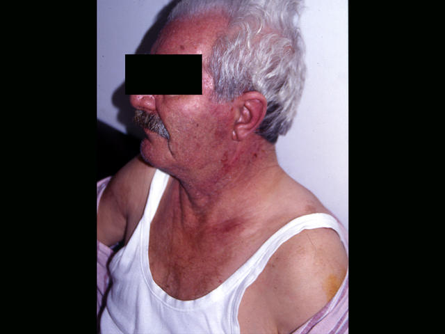 CONNECTIVE TISSUE DISORDERS - Dermatomyositis