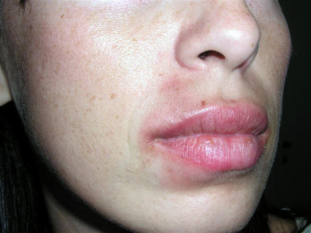 DRUG ERUPTIONS - Fixed drug eruption DRUG ERUPTIONS - Fixed drug eruption