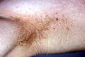 KERATINISATION DISORDERS - Acanthosis nigricans