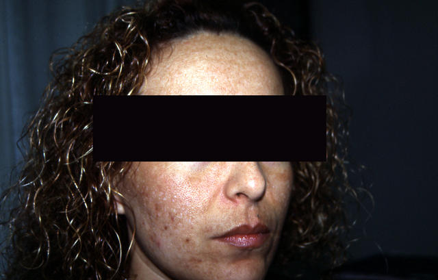 PIGMENTATION DISORDERS - Melasma