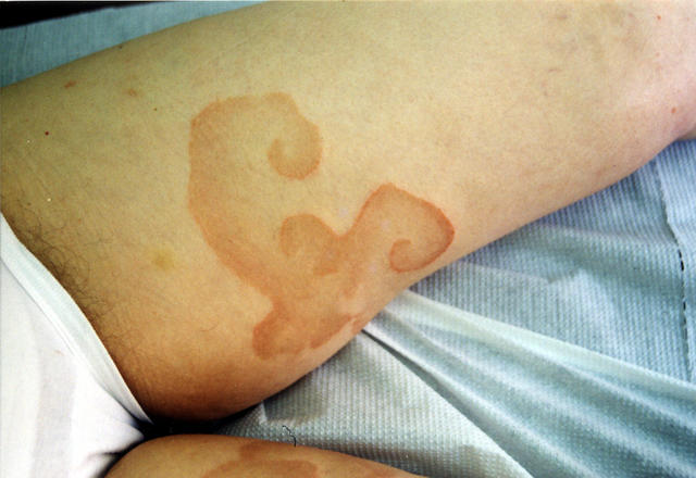 DISEASE OF THE BLOOD AND THE VESSELS – PURPURAS - Erythema annulare centrifugum DISEASE OF THE BLOOD AND THE VESSELS – PURPURAS - Erythema annulare centrifugum