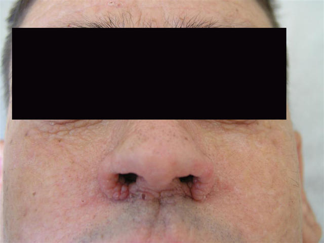 METABOLIC DISEASE, NUTRITION - Lipoid proteinosis (Urbach - Wiethe syndrome) METABOLIC DISEASE, NUTRITION - Lipoid proteinosis (Urbach - Wiethe syndrome)