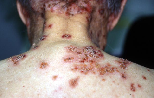 BULLOUS DISEASES - Pemphigus foliaceus