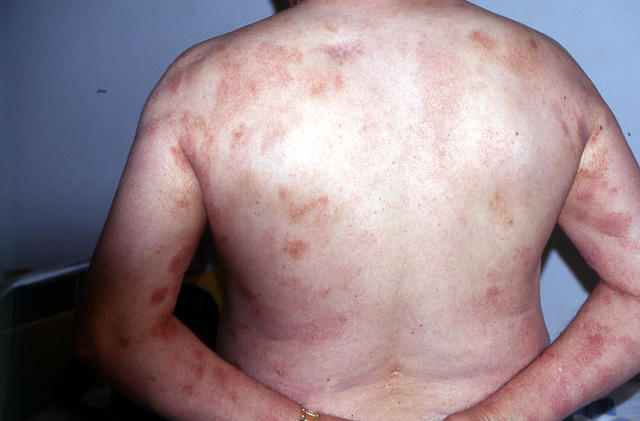 LYMPHOMAS - LYMPHOCYTIC INFILTRATIONS - Mycosis Fungoides LYMPHOMAS - LYMPHOCYTIC INFILTRATIONS - Mycosis Fungoides