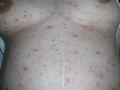 VIRAL INFECTIONS - SmallPox