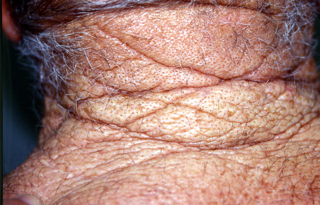 AGEING, PHOTOAGEING - rhomboid neck, Solar elastosis AGEING, PHOTOAGEING - rhomboid neck, Solar elastosis