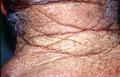 AGEING, PHOTOAGEING - rhomboid neck, Solar elastosis