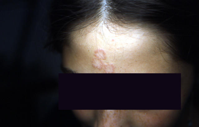 SUPERFICIAL FUNGAL INFECTIONS - Tinea faciale