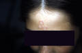 SUPERFICIAL FUNGAL INFECTIONS - Tinea faciale