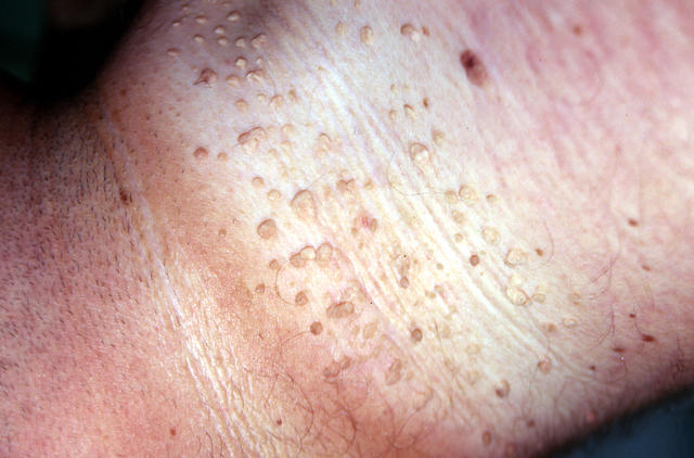 KERATINISATION DISORDERS - Acanthosis nigricans KERATINISATION DISORDERS - Acanthosis nigricans