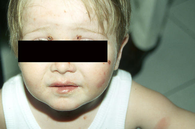 CONNECTIVE TISSUE DISORDERS - Epidermolysis bullosa aquisita