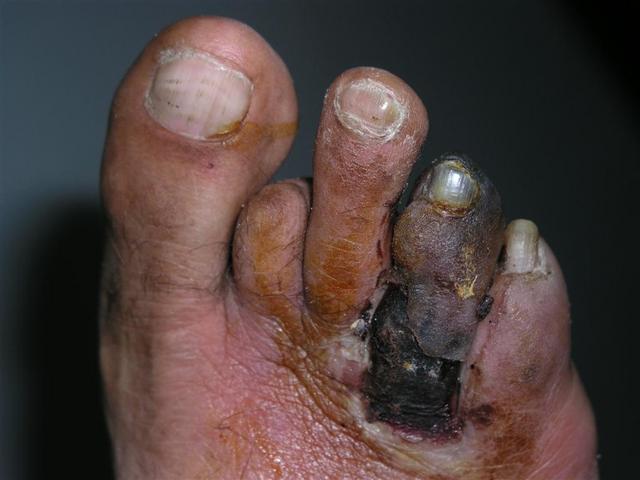 METABOLIC DISEASE, NUTRITION - Gangrene in a patient with Diabetes Mellitus