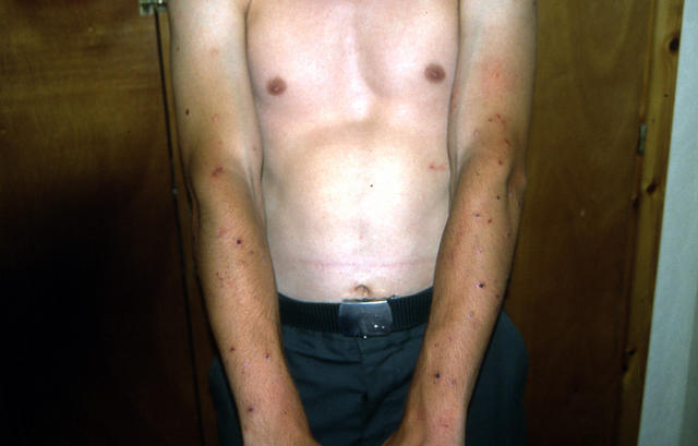 PARASITOSES, BITES - Insect bites PARASITOSES, BITES - Insect bites